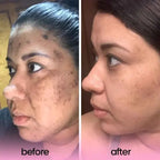 Turmeric and Kojic Acid Pads For Dark Spots| Exfoliating Cleansing Pads for All Skin Types - 40 pads