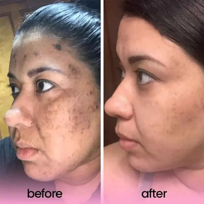 Turmeric and Kojic Acid Pads For Dark Spots| Exfoliating Cleansing Pads for All Skin Types - 40 pads